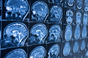 How Much Does It Cost to Hire a Brain Injury Lawyer?